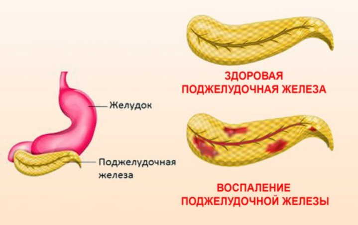 Случай излечения воспаления поджелудочной железы при помощи бархатцев и золотого уса