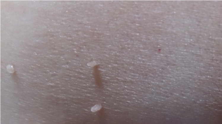 Меланома - самая опасная разновидность рака кожи. Можно ли удалять родинки? И как понять, что родинка безопасна?