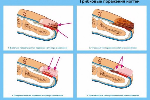 Как вылечить грибок на ногтях?