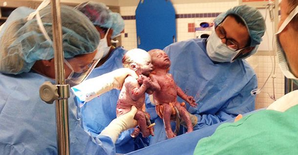 Помните этих близнецов, которые держались за руки при рождении? Посмотрите на них сегодня!