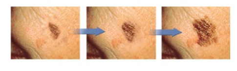 Меланома - самая опасная разновидность рака кожи. Можно ли удалять родинки? И как понять, что родинка безопасна?