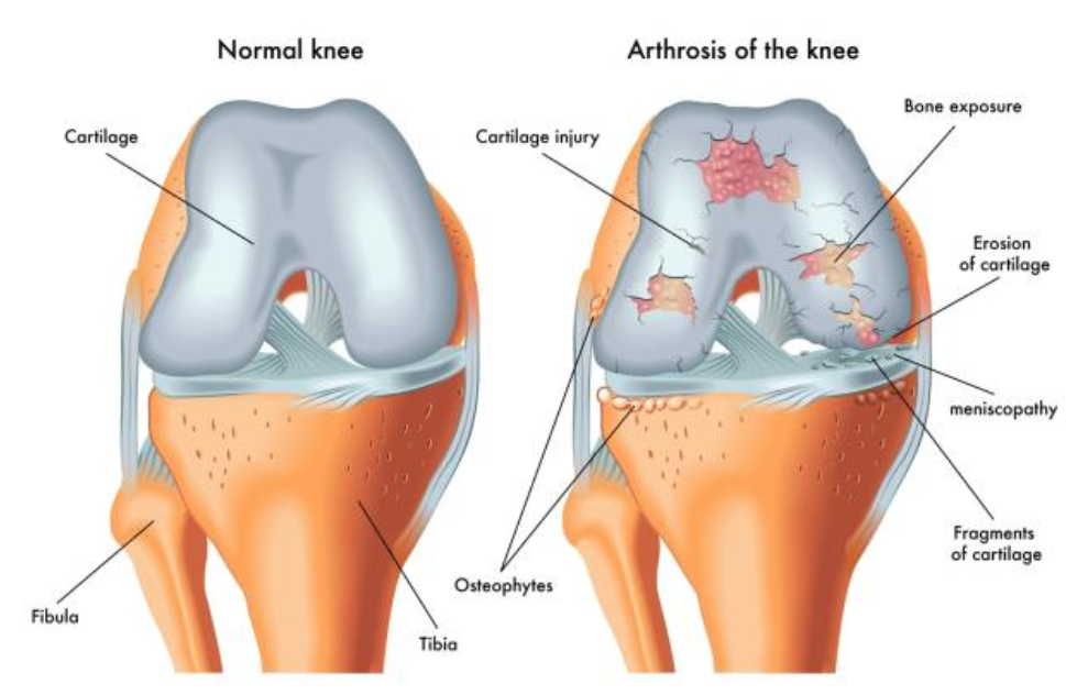 17 рецептов для лечения суставов