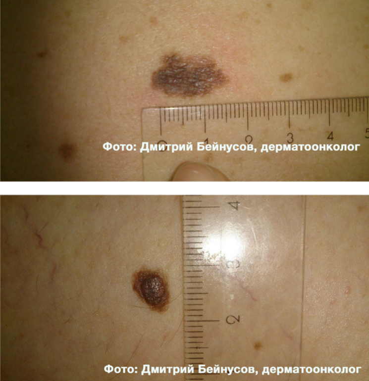 Меланома - самая опасная разновидность рака кожи. Можно ли удалять родинки? И как понять, что родинка безопасна?