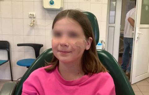 Девочку из Сочи, которой собака подруги откусила щеку, выписали из больницы