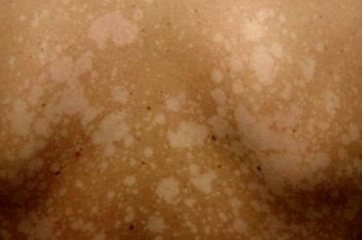 Солнечный лишай: чем опасна пляжная болезнь и как ее лечить