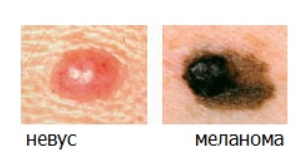 Меланома - самая опасная разновидность рака кожи. Можно ли удалять родинки? И как понять, что родинка безопасна?
