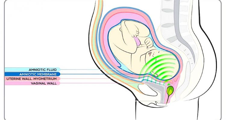 В США создали музыкальную колонку для вагины — ее вставляют роженицы, чтобы плод тоже мог слушать музыку 