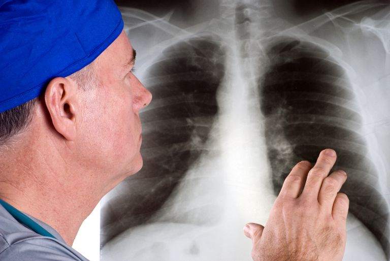 Ком в груди: к какому врачу обращаться? Что показывает рентген грудной клетки?
