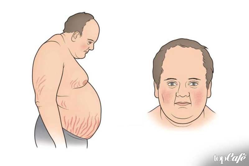 Синдром Иценко-Кушинга