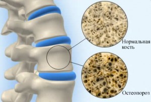 Как лечить остеопороз костей народными средствами