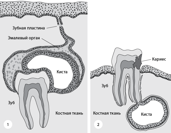 Разновидности кисты зуба