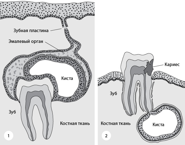 Киста зуба: причины образования, симптомы, лечение болезни,здоровье,киста зуба,стоматология