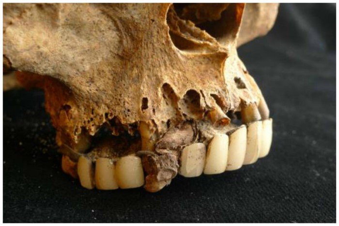 Что делали стоматологи прошлого челюсть, делали, челюсти, вставная, страшно, протезы, бегемота, кости, эмаль16Серебряные, изготовлены, передние, протезе, нижнем, частично, верхнем, полном, около, пружинами, проволочными, букальными