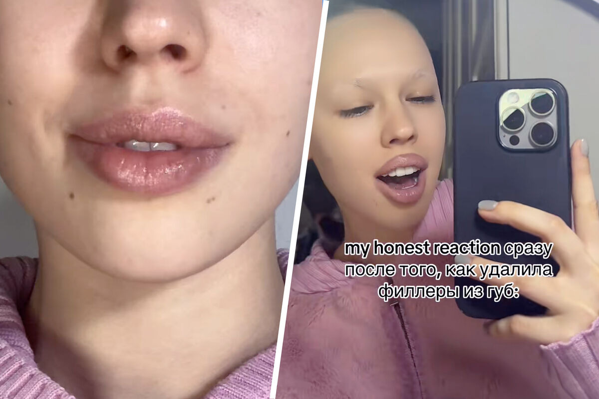Рэперша Инстасамка выложила видео после удаления филлеров из губ