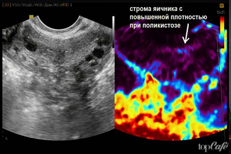 Поликистоз - одна из болезней, от которых можно набрать вес