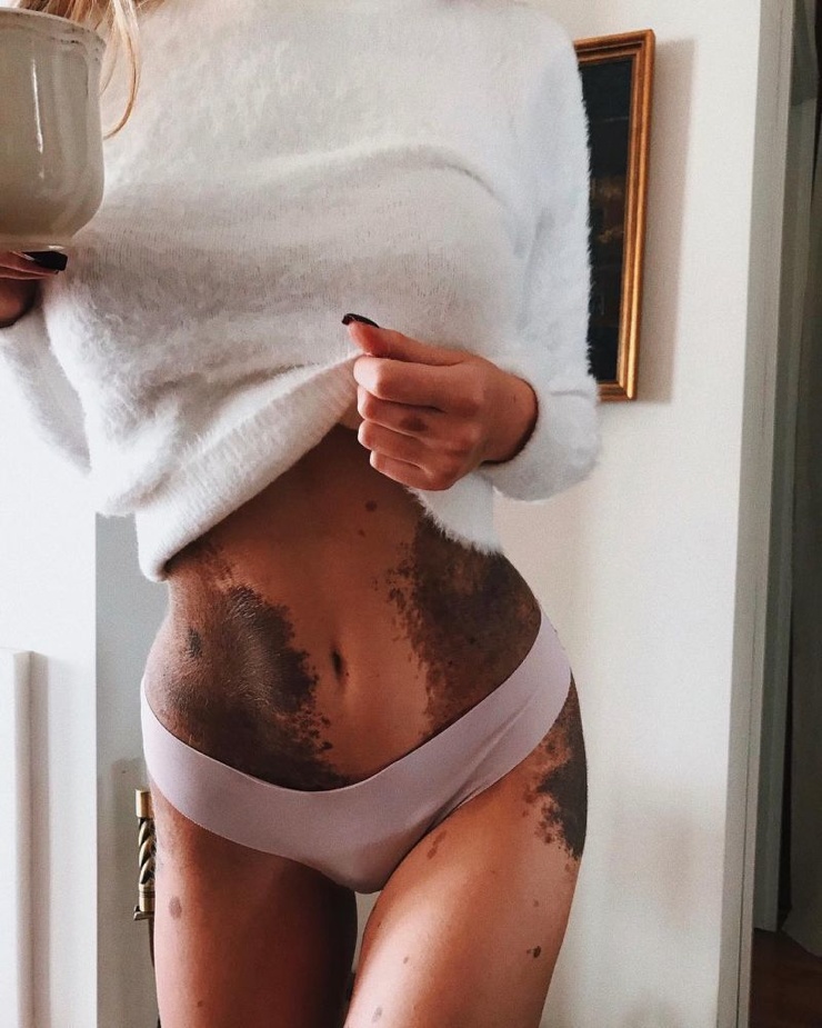 Девушка с огромной родинкой показалась в нижнем белье, и ее осыпали комплиментами Девушка с огромной родинкой показалась в нижнем белье, и ее осыпали комплиментами