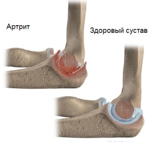 artrit-loktevogo-sustava