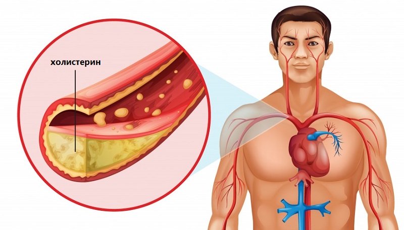 Холистерин блокирует сосуды