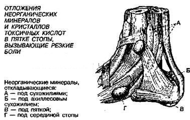 Шпоры и образования в суставах: тест Брэгга на заизвесткованность неорганическими, очень, кислот, можно, которых, минералы, стопы, чтобы, только, токсичных, время, многие, кровообращения, этого, когда, неорганических, болезней, минералами, минералов, кристаллы