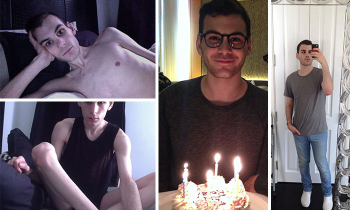 Люди победившие анорексию фото до и после