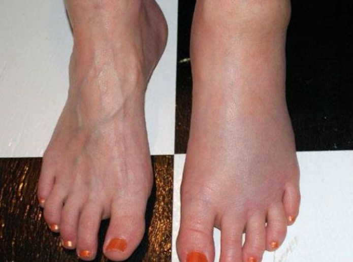 Семена льна от отеков ног: 8 простых рецептов снять отечность с ног. Простое лечение без таблеток