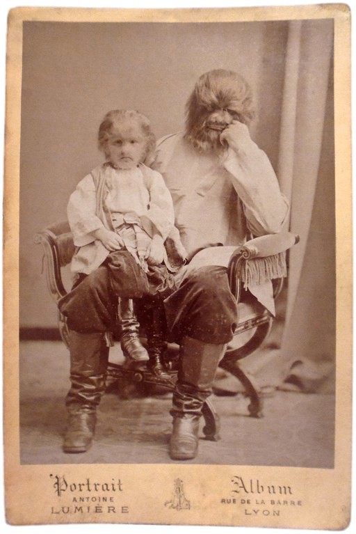 Больные гипертрихозом Адриан и Федор Евтихиевы, 1870-е. история, события, фото