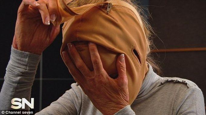 Жизнь без лица закончена: австралийка сняла маску, которую носила 2,5 года (18 фото)