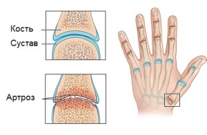 artroz-kistej-palcev-ruk