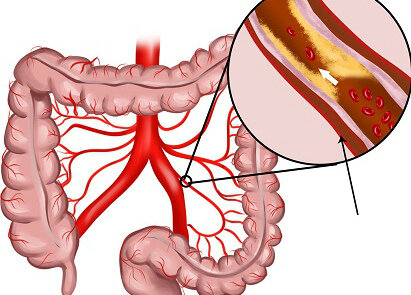 Первые симптомы атеросклероза сосудов кишечника атеросклероз,болезни,здоровье,сосуды,холестерин