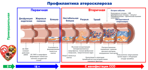 Три этапа профилактики и механизм развития и прогрессирования атеросклероза
