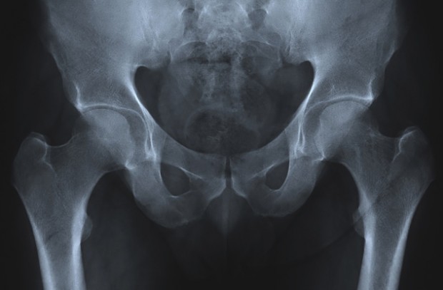 Тазовая кость на рентгеновском снимке
