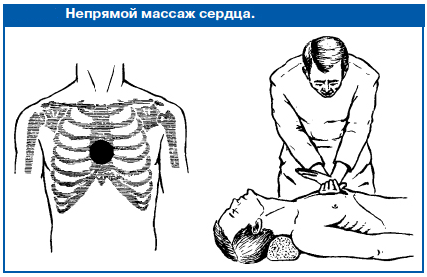 Первая помощь при утоплении легких, дыхательных, после, можно, путей, помощи, будет, крови, случае, утонувшего, только, когда, сердца, утоплении, состояние, признаков, этого, время, пострадавшего, быстро