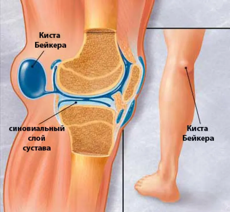 Киста Бейкера – что это, как обнаружить и лечить? боль в коленях,грыжа,здоровье,киста,киста бейкера,колено,медицина
