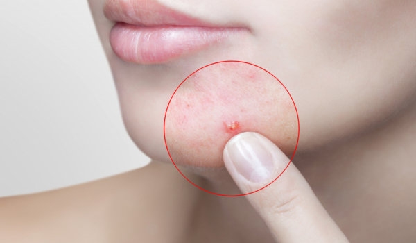 Красные прыщики на лице-как себе помочь ?