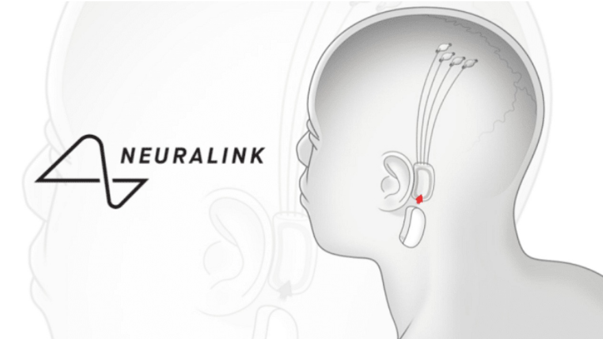 Neuralink чип. Имплант Neuralink мозговой. Neuralink Илон Маск. Нейролинк имплант.