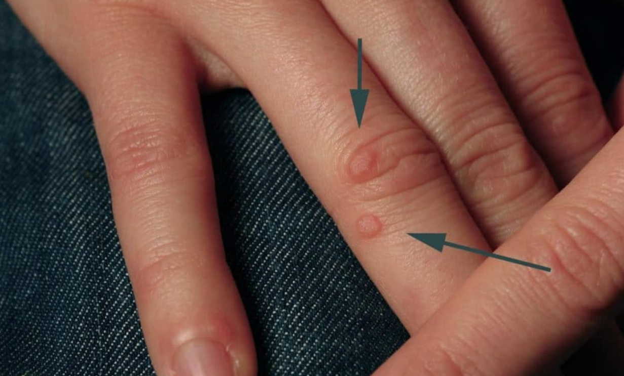 Избавляемся от бородавок и мозолей без проблем и без боли!