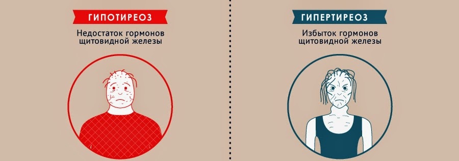 Как Похудеть При Гипотиреозе.