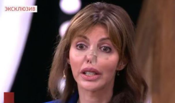 Почти лишившаяся носа Алиса Казьмина пришла в студию шоу Андрея Малахова
