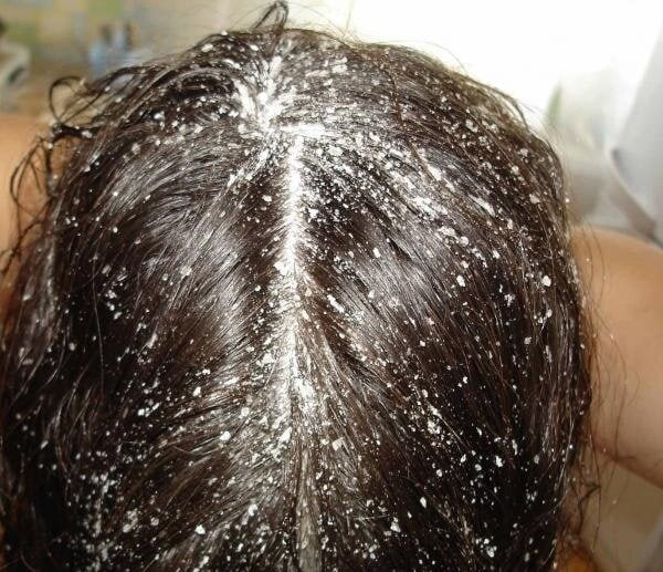 Останавливаем выпадение волос при помощи простого трюка волосы, головы, процедуры, делать, этого, шампунем, можно, просто, ваннуПосле, принимая, параллельно, Секрет, обычным, шапочку, собрать, Можно, полчаса, волосах, оставьте, промойте