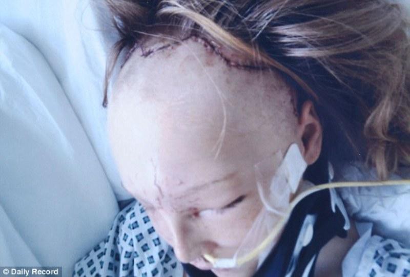Хирурги сняли лицо девочке, попавшей в аварию, чтобы собрать по частям ее череп авария, лицо, операция