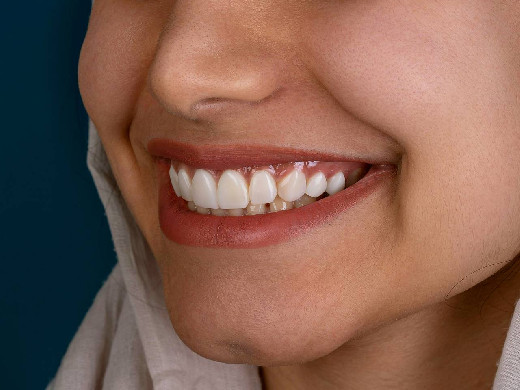 Россиян предупредили об опасности наращивания зубов гель-лаком