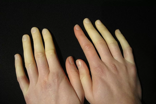 15 интересных фактов о людях людей, называется, человека, палец, только, много, менее, пальцы, особенность, стопы, строение, встречаются, встречается, складка, редко, обладают, планете, каждого, могут, слышать