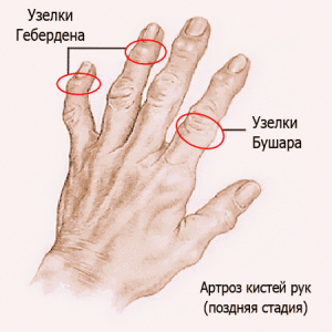 hand-osteoarthritis2