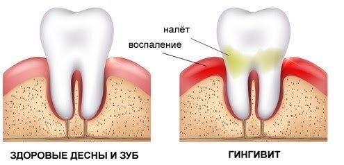 6 вопросов стоматологу о воспалении десен воспаление десен,стоматология