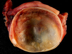 250px-benign_ovarian_cyst