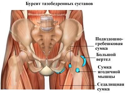 bursit-prichiny-simptomy-lechenie_4