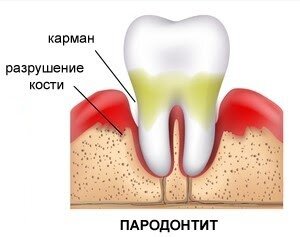 6 вопросов стоматологу о воспалении десен десны, зубов, зубной, десна, лечения, чистки, человек, десной, помощью, камни, более, налет, нужно, может, воспаление, десен, жизни, пародонтит, которые, очистки