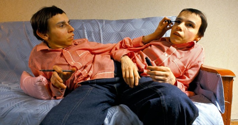 Трагическая история жизни и смерти сестер Кривошляповых — первых в СССР сиамских близнецов