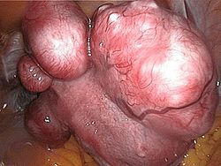 250px-uterine_fibroids