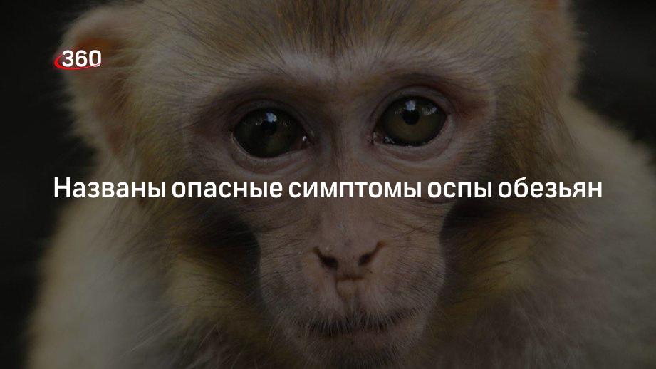 Оспа обезьян опасна для человека. Симптомы оспы обезьян у человека. Обезьянья оспа симптомы у человека фото.